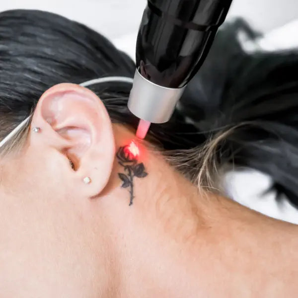 How does laser tattoo removal work?